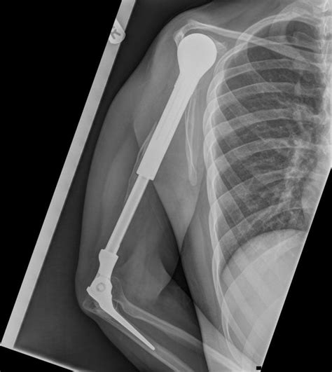 boxer metal implant right arm|metal implant removal reviews.